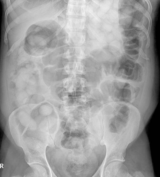 腹部 xray を示す違法な薬物密輸 ストックフォト