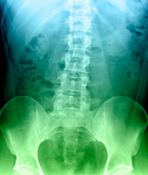Scoliosis lumbar vertebrae stock photo