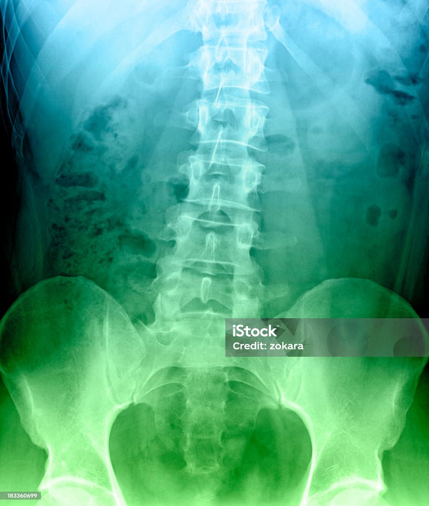 Escoliose de vértebras lombares - Royalty-free Anatomia Foto de stock