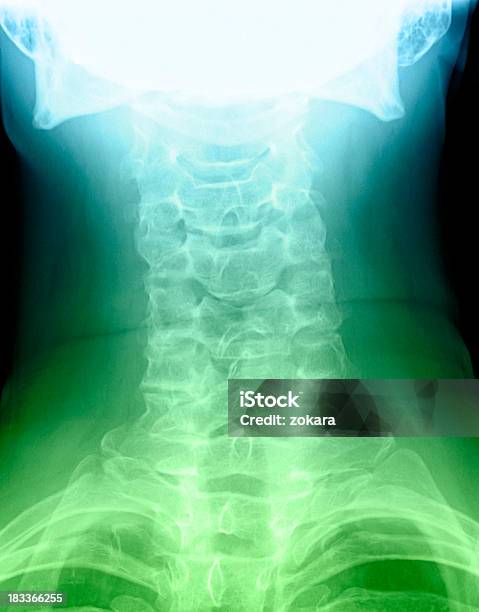 Vertebra Cervicale Scoliosi - Fotografie stock e altre immagini di Blu - Blu, Colore verde, Osso umano