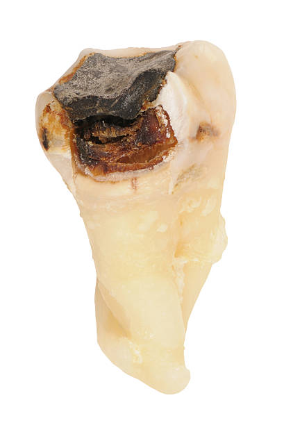 decayed human tooth with Karies, Cavity stock photo