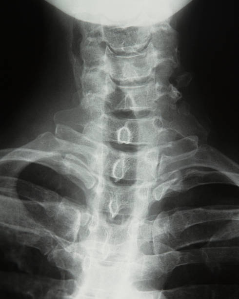 istock X-ray of Broken Neck From Cougar Attack 183377473