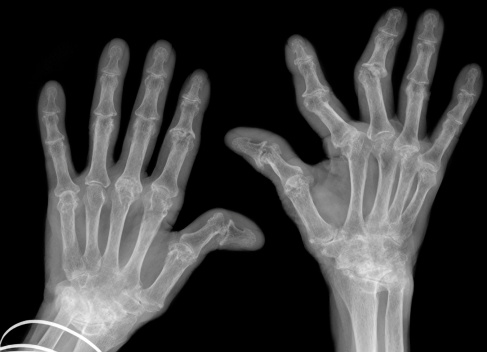 Digital xrays of both hands showing severe rheumatoid arthritis affecting both wrists and hands. Deformities limiting movement and associated with pain.