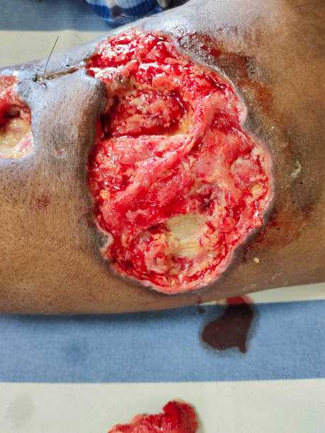 Uma grande úlcera na coxa de um paciente com fascite necrosante Uma foto de uma grande úlcera na coxa de um paciente com fascite necrosante, uma infecção bacteriana rara que se espalha rapidamente pelo corpo e pode causar morte fotos de estoque de bactérias comedoras de carne, fotos e imagens livres de direitos autorais