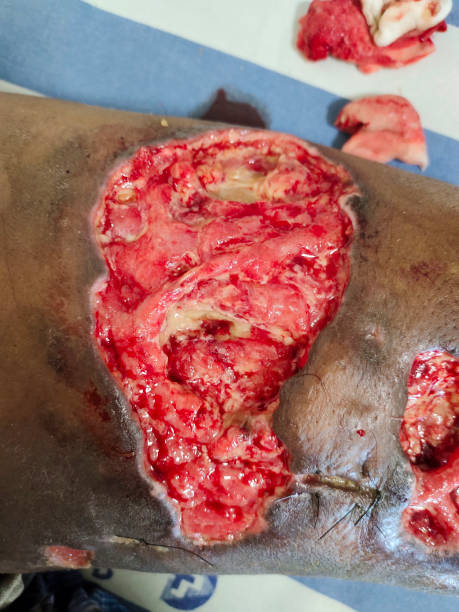 A large ulcer in the thigh of a patient with necrotizing fasciitis A picture of a large ulcer in the thigh of a patient with necrotizing fasciitis which is a rare bacterial infection that spreads quickly in the body and can cause death fournier gangrene stock pictures, royalty-free photos & images