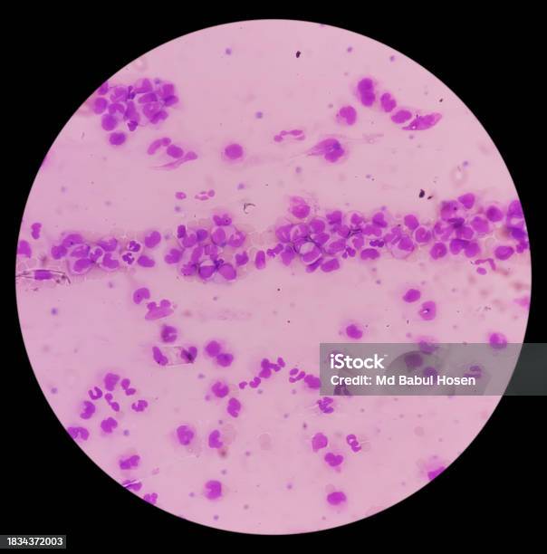 Leucemia Leucocitosi Con Monocitosi Con Mielociti Occasionali Osservati