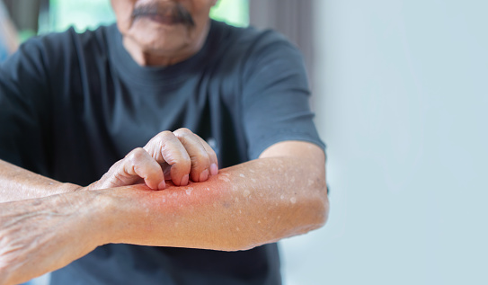 Cropped image of Asian elder man scratching his forearm. Concept of itchy skin diseases such as scabies, fungal infection. Selective focus, copy space.