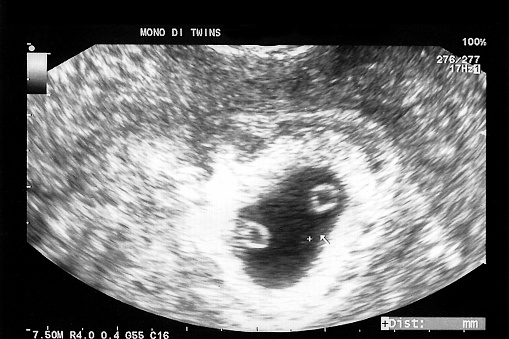 Anatomy scan of twin gestation 6 weeks  monochorionic diamniotic.
