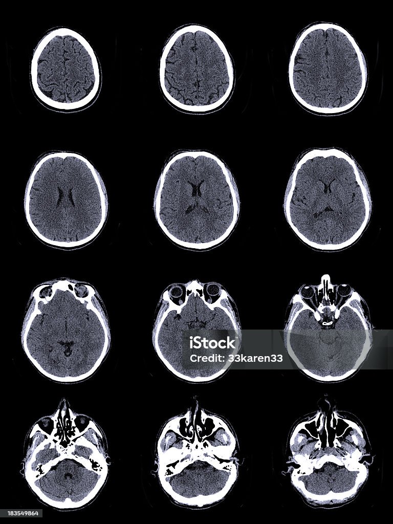 Ct Scan Brainline Brain Ct Scan Stock Photo - Download Image Now - Anatomy, Beauty, Brain ...