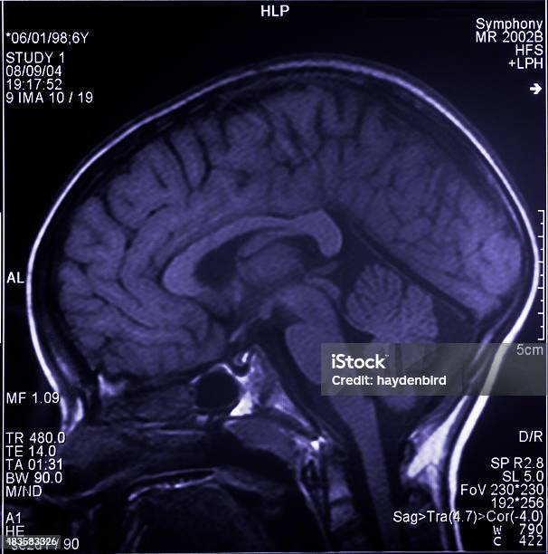 Photo libre de droit de Cerveau Montrant Scanner À Résonance Magnétique Plusieurs Images De La Tête Et Du Crâne banque d'images et plus d'images libres de droit de Image par résonance magnétique