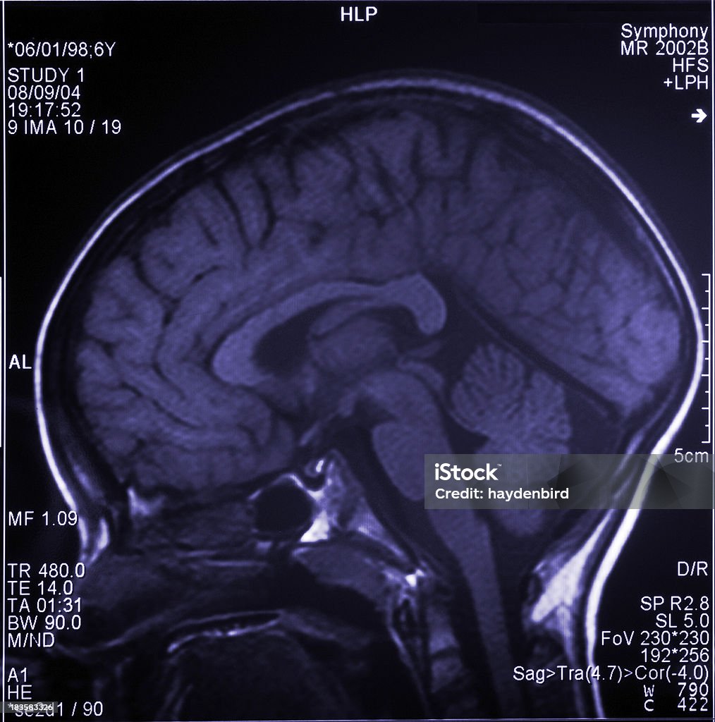Scansione RM cerebrale con più immagini di testa e teschio - Foto stock royalty-free di RMN