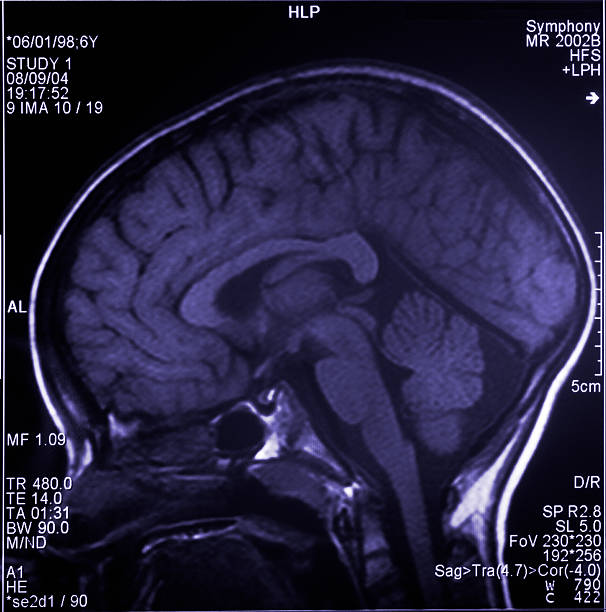 mri cérebro scan mostrando várias imagens da cabeça e crânio - corpus striatum - fotografias e filmes do acervo