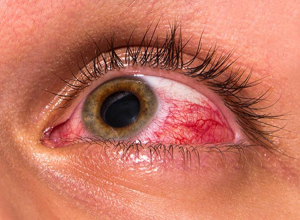 istock A close up of an eye aggravation after working at computer  183637776