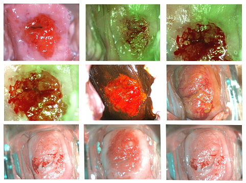 Colposcopy of the cervix. Staining with iodine and acetic acid. Collage set of photos. Medical examination of the mucous membrane. Skin analysis.