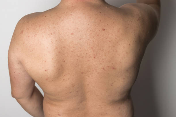 istock Naked man with red pimples on his back, acne skin disease, dermatology problem 1837147066