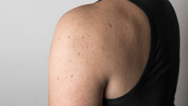 istock Man in t-shirt with red pimples on his skin, acne disease, dermatology problem 1837147406