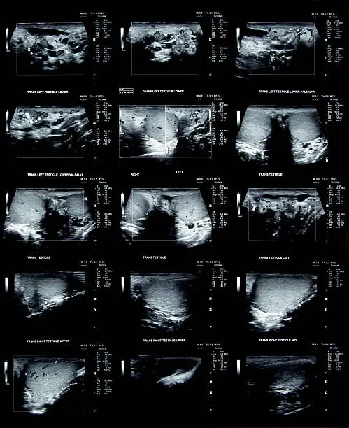 Testicular ultrasound film to check for problems