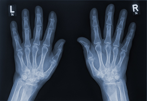 x-ray-of-a-left-hand-and-right-hand.jpg?