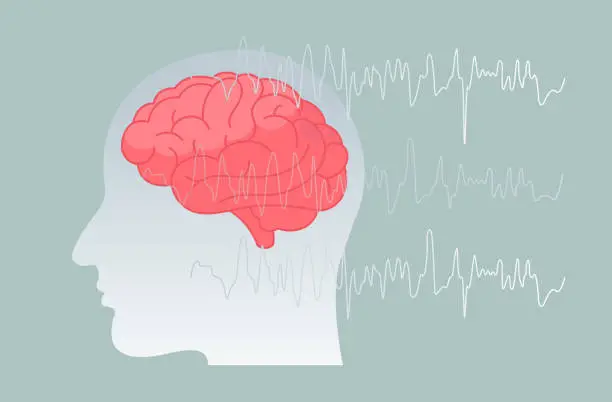 Vector illustration of Epilepsy - A Neurological Condition - Stock Illustration