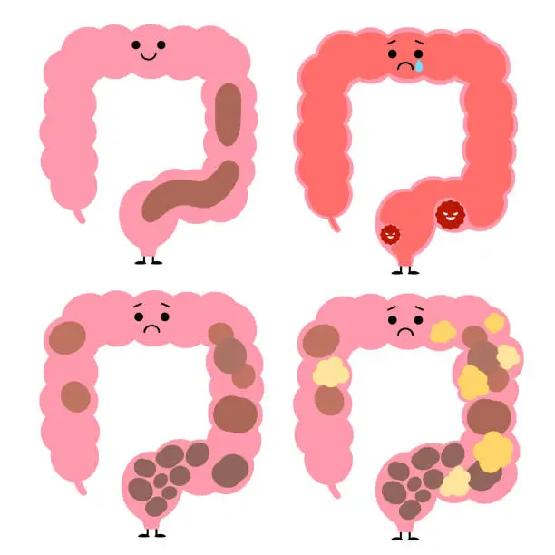 Vector illustration of Large intestine set with various bowel movements and tumors