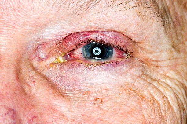 infección ocular - pain human eye senior adult men fotografías e imágenes de stock