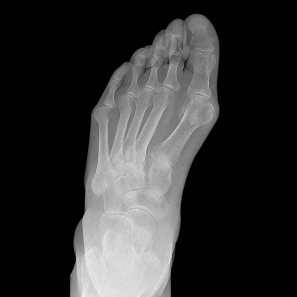 X-선 of foot 표시중 엄지발가락굽음증 및 hallux valgus 변형 스톡 사진