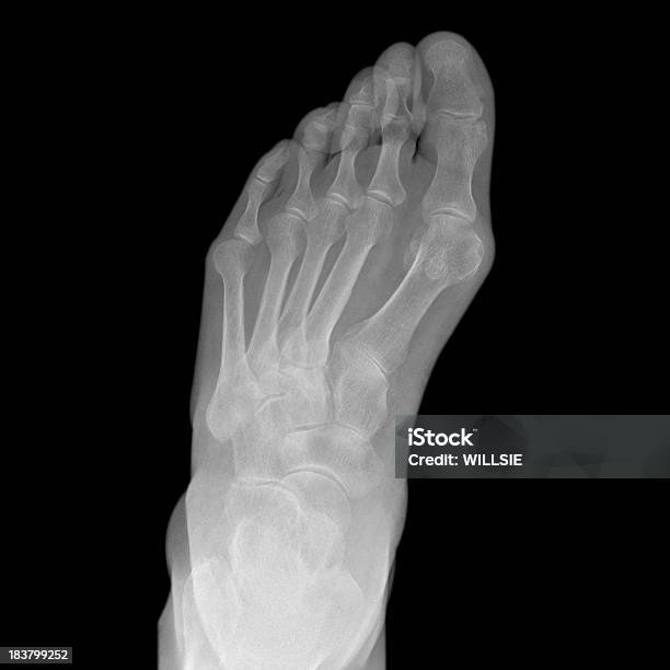 Xray De Pé Mostrando Joanete E Hallux Valgus Deformação - Fotografias de stock e mais imagens de Joanete