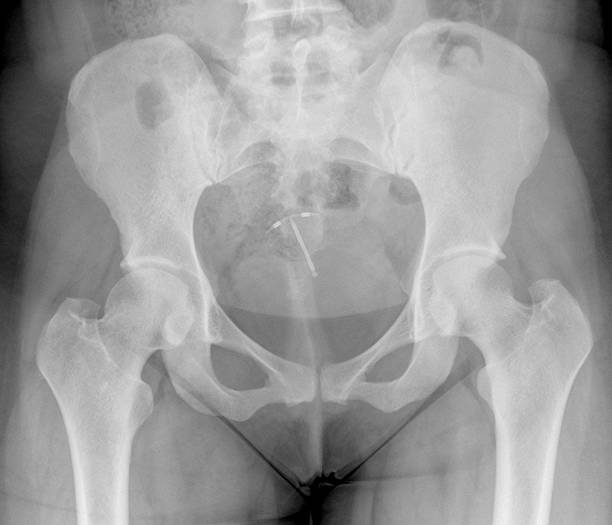 골반 X-선 표시중 자궁내 피임 기기 스톡 사진