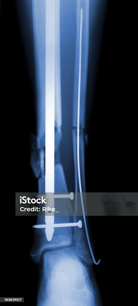Original de una imagen radiográfica de la parte inferior de las piernas - Foto de stock de Alambre libre de derechos