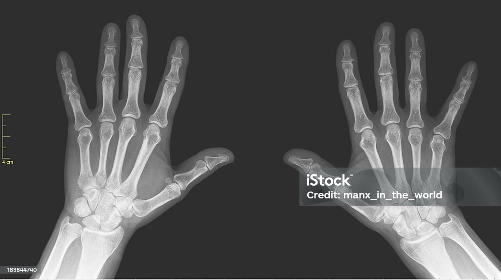 X-ray de mains - Photo de Gammagraphie libre de droits