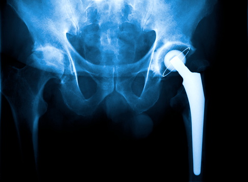 Real X-ray of a Arthroplasty of the hip joint. (Abbreviation: HTP or H-TEP) 