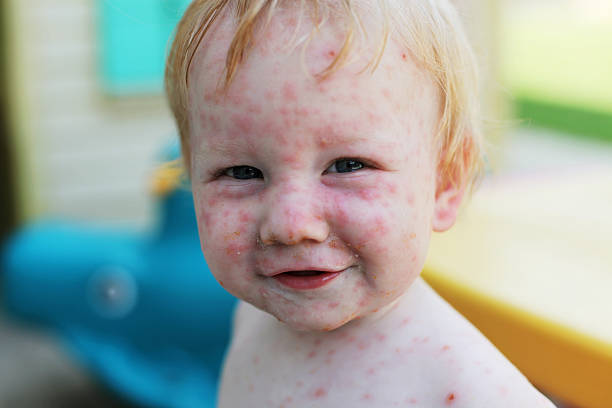 2,900+ Child Chicken Pox Stock Photos, Pictures & Royalty-Free Images