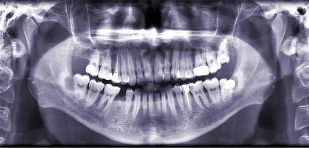istock X-Ray results of a set of teeth 183894040