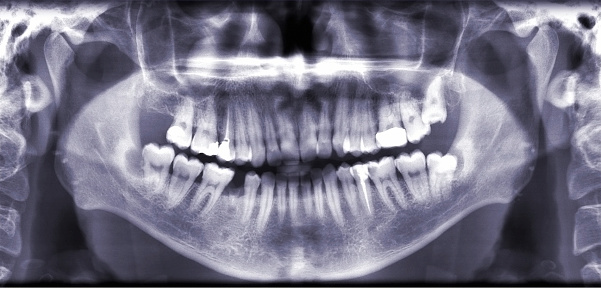 panoramic X-ray of teeth and jaw.