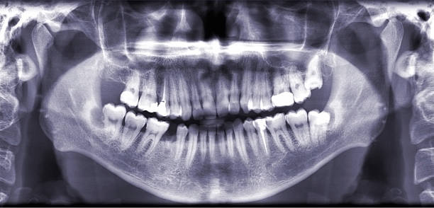 Zdjęcie rentgenowskie zębów – zdjęcie