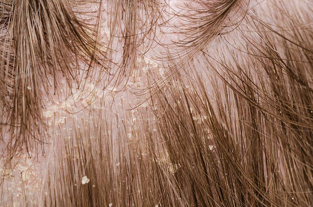 Close-up of scalp with dandruff flakes and brown hair stock photo