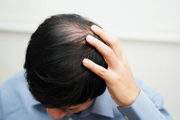 istock Bald head in man, hair loss treatment health problem. 1840121680