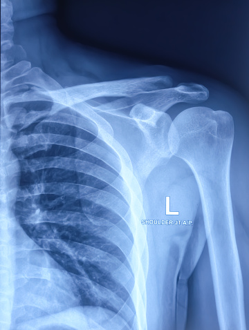 Shoulder joint x-ray. abduction movement restricted.