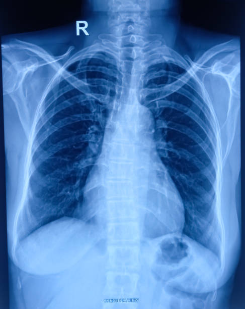 istock Pneumonitis(right), CXR (Chest X-Ray) PA view. 1840234063