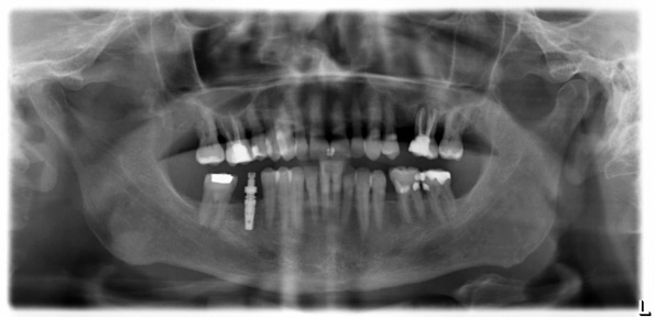 Dental X-Ray of the yaws with dental Implant