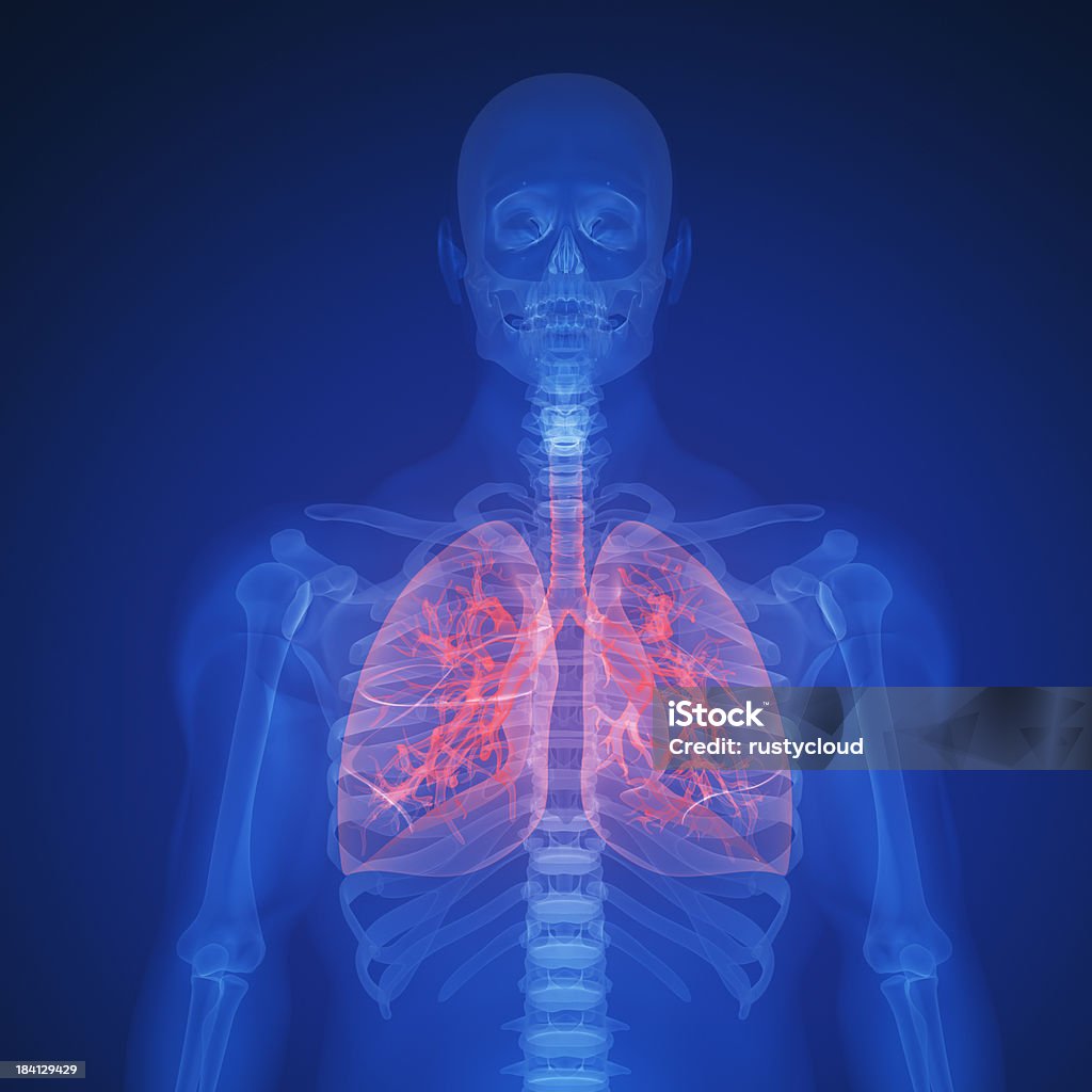 infection du poumon - Photo de Cancer des poumons libre de droits