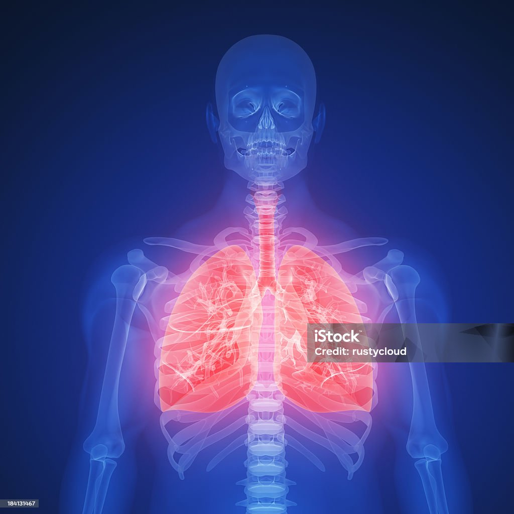 Infekcja płuc - Zbiór zdjęć royalty-free (Rak płuca)