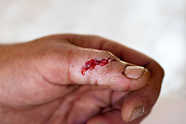 Dealing with open wounds after injury from saw stock photo