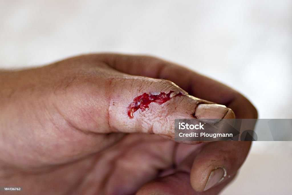 Дело с открытые раны после повреждения от пила - Стоковые фото Рана роялти-фри