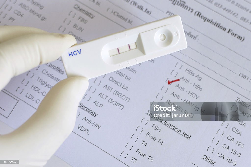 Hepatitis C virus (HCV) positive Detection of hepatitis C virus (HCV) by using test cassette, the result show positive (double red band) Analyzing Stock Photo