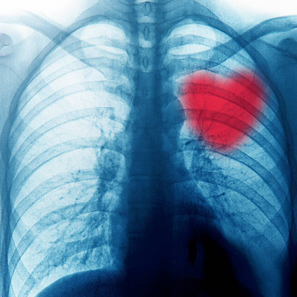 Cтоковое фото Рентгенография грудной клетки с красное сердце