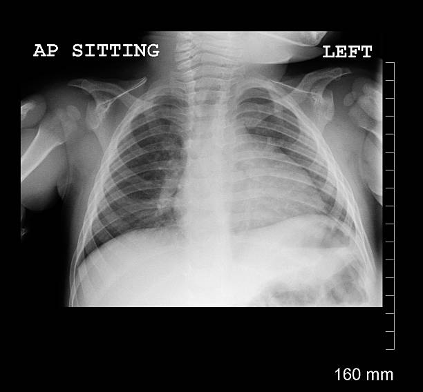 pediatric органов грудной клетки - x ray x ray image chest human lung стоковые фото и изображения