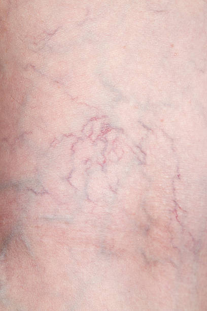 Human Spider Veins on Leg Closeup stock photo