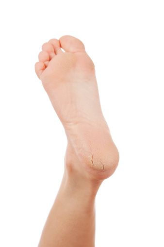 Dry and cracked woman's heel on white background.  You might also be interested in these: