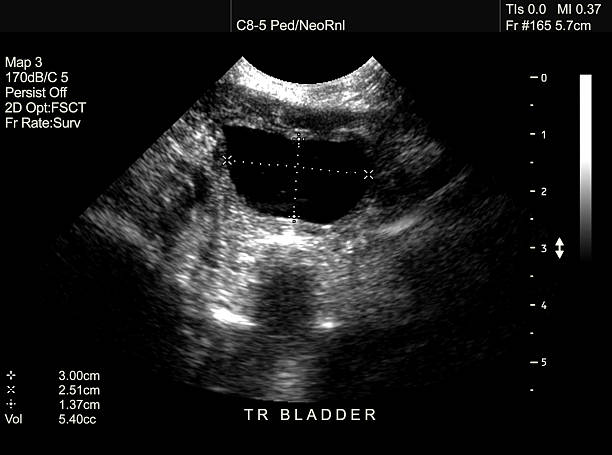 istock Ultrasound scan of newborn bladder 184295462